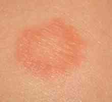 Mjesta na koži kao što su opekline: mogući uzroci