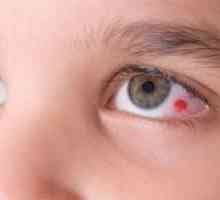 Glavni razlozi za burst krvnih žila u očima