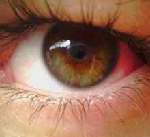 Zašto praska kapilare u očima? Uzroci i prevencija