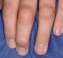 Zašto nabubri falanga prstiju i kako liječiti
