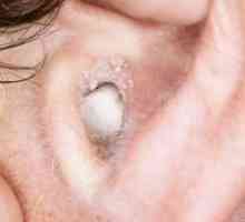 Zašto se i kako liječiti gljivice u ušima?