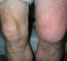 Zašto mi se i što je bolest praćena oticanje zgloba koljena