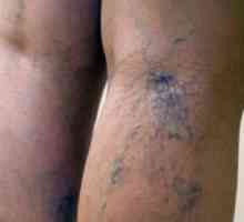 Zašto modrice na nogama bez razloga u žena? Krhki zglobova, krvnih bolesti.