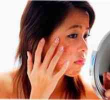 Tinejdžerski akne - kako izliječiti acne vulgaris?