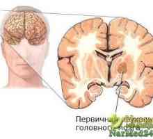Improvizirani narodnih lijekova za liječenje tumora mozga