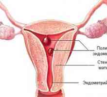 Endometrija polipoza
