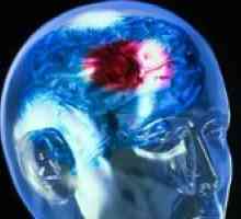 Posljedice i prognoza nakon hemoragijski moždani udar