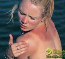Praktični narodnih lijekova za sunčanje opeklina i prve pomoći kad se pojave