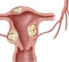 Ginekoloških bolesti za vrijeme menopauze