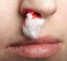 Uzroci čestih krvarenja iz nosa i načinu zaustavljanja