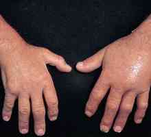 Uzroci i liječenje ruku edema