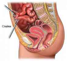 Razlozi za formiranje priraslica u crijevima i kako ih liječiti