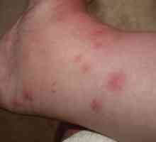 Uzroci edema u alergije i kako ih riješiti
