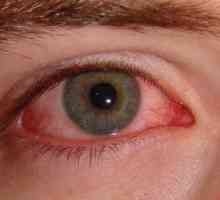 Uzroci i liječenje alergijske oka edema
