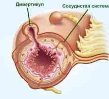 Uzroci crijevne divertikula