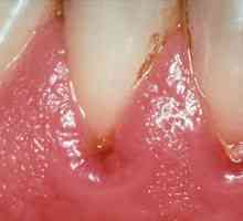 Uzroci i liječenje zubnog apscesa