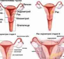 Uzroci i liječenje hiperplazije endometrija maternice