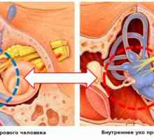 Uzroci, simptomi i liječenje Meniereovog bolesti