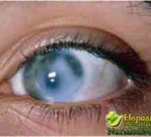 Simptomi i liječenje glaukoma narodnih lijekova