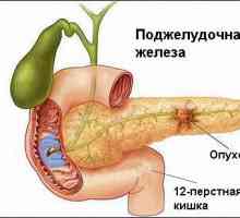 Značajke i postupci liječenja raka pankreasa