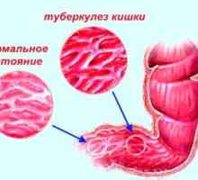 Simptomi crijevne tuberkuloze