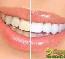 Stručni izbjeljivanje zubi bez pomoći stomatologa kod kuće