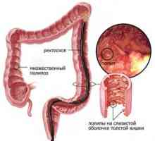Koje metode uklanjanje polipa u crijevima?