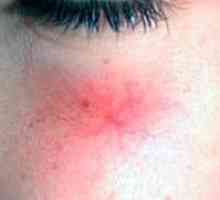 Prevencija i liječenje pauk vene na licu