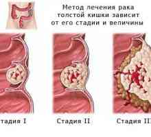Tretman i prognozu adenokarcinoma debelog crijeva sigmoidalne
