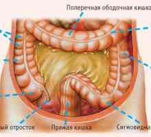 Uzroci diverticulosis debelog crijeva