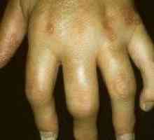 Psorijatični artritis