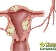 Rad narodnih lijekova u liječenju maternice adenomioze
