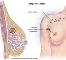 Rak dojke (mliječna žlijezda)