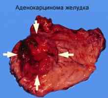 Opće informacije o simptomima ciroze jetre