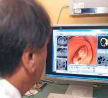 Rak debelog crijeva je pronađen u ranoj fazi