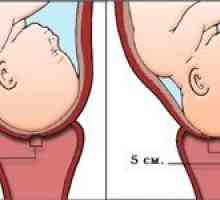 Cerviks prije poroda