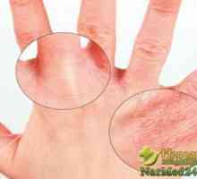Prepoznavanje, prevencija i liječenje kontaktni dermatitis u kući