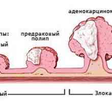 Simptomatologija od raka debelog crijeva u muškaraca