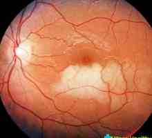 Stratifikacija mrežnice očiju: uzroci i posljedice