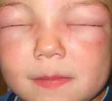 Manifestacije i liječenje angioedema u djece