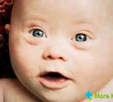 Razvoj djece s Downovim sindromom: karakteristike i razlike između normalnog djeteta