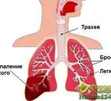 Rizik od upale pluća u odraslih i djece