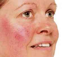 Rosacea na licu - simptomi, uzroci i liječenje