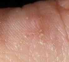 Seboreični dermatitis na licu