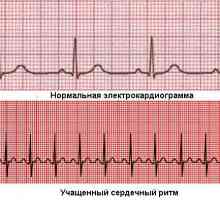 Srca: visoka i normalno, uzrokuje češće, što i kako liječiti?