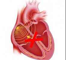 Srce blok: pune i djelomične, različite lokacije - uzroci, simptomi, liječenje