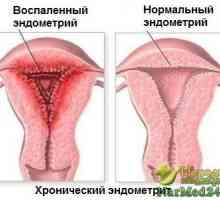 Moć bilja u liječenju endometrioza