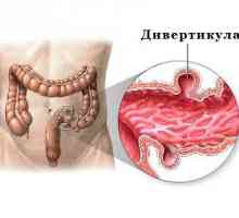 Simptomatologije i liječenje divertikulitisa u sigmoidnom debelom crijevu