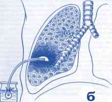 Simptomatologije i liječenje plućne čir