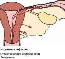 Simptomi i tretman adneksitisa kod žena